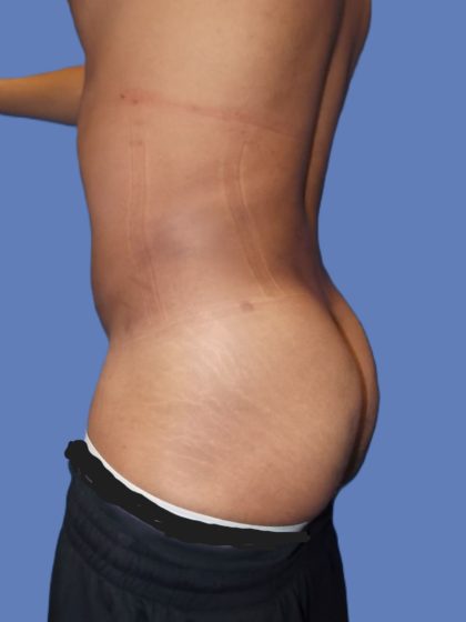 Body Contouring Before & After Patient #5218