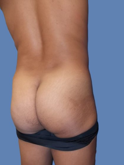 Body Contouring Before & After Patient #5218