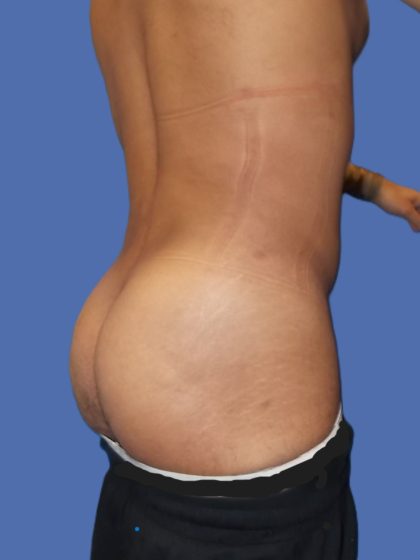 Body Contouring Before & After Patient #5218
