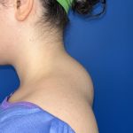 Liposuction Before & After Patient #5281