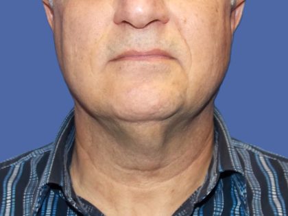 Submental Liposuction Before & After Patient #5291