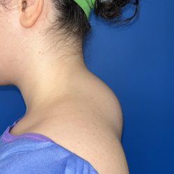 Liposuction Before & After Patient #5281