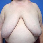 Local Flap Breast Reconstruction Before & After Patient #5336