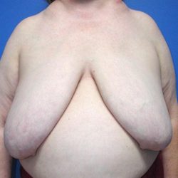 Local Flap Breast Reconstruction Before & After Patient #5336