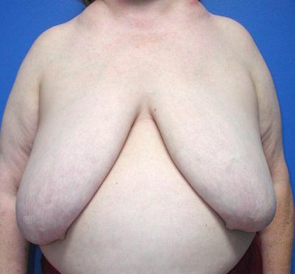 Local Flap Breast Reconstruction Before & After Patient #5336