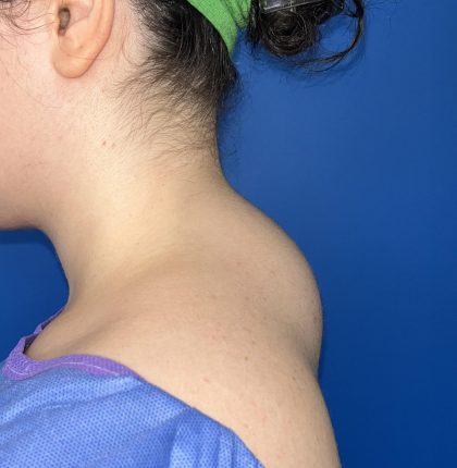 Liposuction Before & After Patient #5281