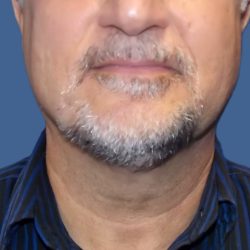 Submental Liposuction Before & After Patient #5291