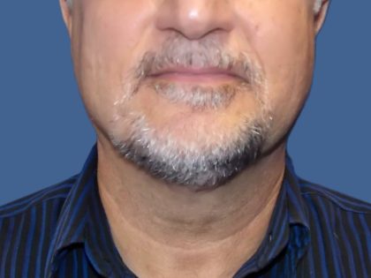Submental Liposuction Before & After Patient #5291