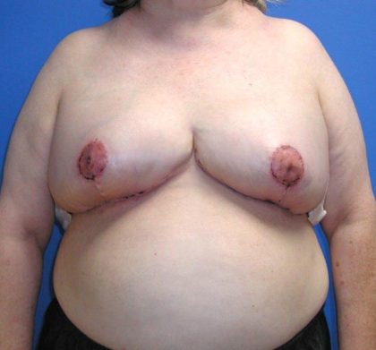 Local Flap Breast Reconstruction Before & After Patient #5336