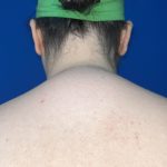 Liposuction Before & After Patient #5281
