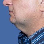 Submental Liposuction Before & After Patient #5291