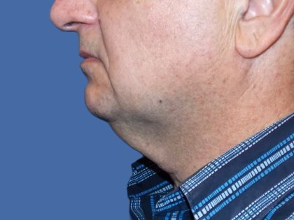 Submental Liposuction Before & After Patient #5291