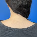 Liposuction Before & After Patient #5281