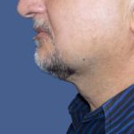 Submental Liposuction Before & After Patient #5291