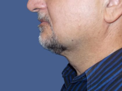 Submental Liposuction Before & After Patient #5291