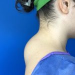 Liposuction Before & After Patient #5281