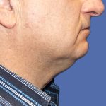 Submental Liposuction Before & After Patient #5291