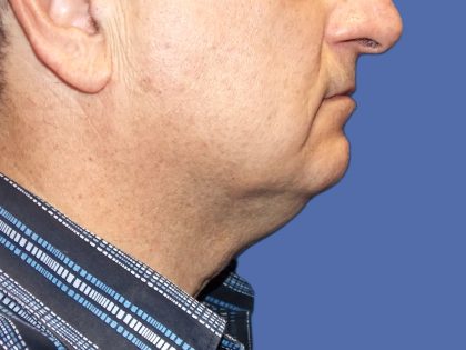 Submental Liposuction Before & After Patient #5291