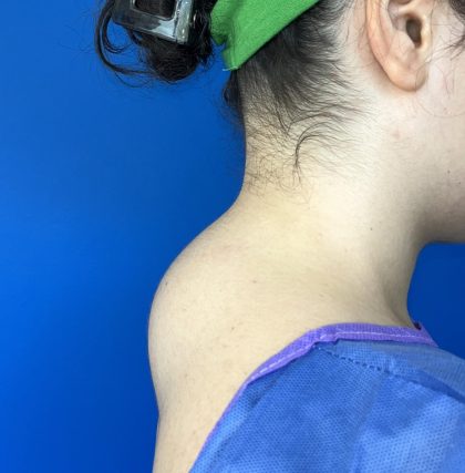 Liposuction Before & After Patient #5281