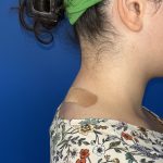Liposuction Before & After Patient #5281