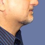 Submental Liposuction Before & After Patient #5291