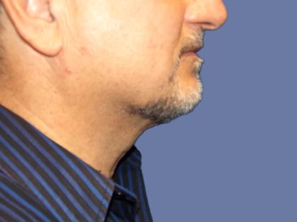 Submental Liposuction Before & After Patient #5291