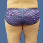 Body Contouring Before & After Patient #5346