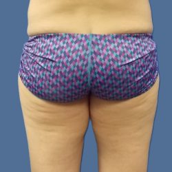 Body Contouring Before & After Patient #5346
