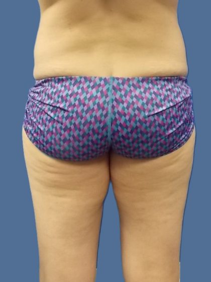 Body Contouring Before & After Patient #5346