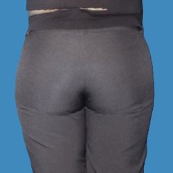 Body Contouring Before & After Patient #5346