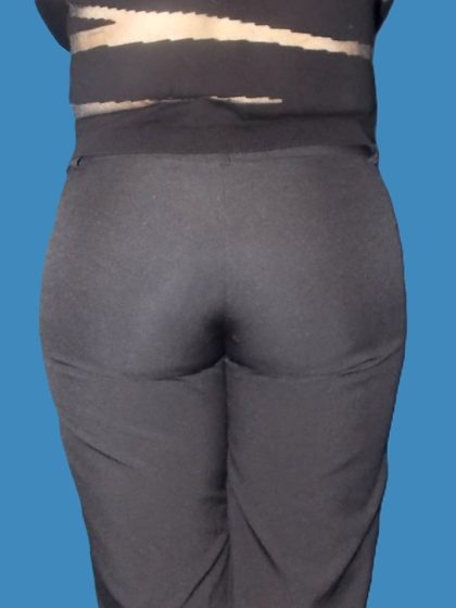 Body Contouring Before & After Patient #5346