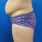 Body Contouring Before & After Patient #5346