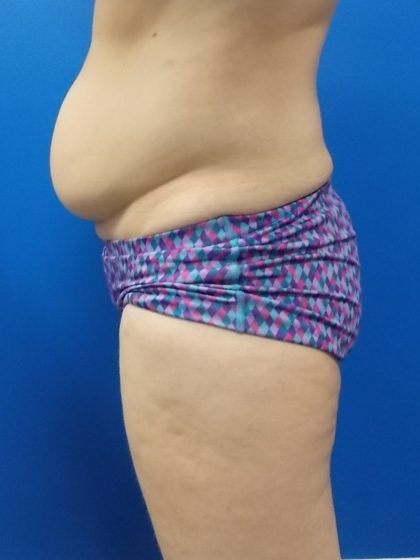 Body Contouring Before & After Patient #5346