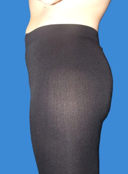 Body Contouring Before & After Patient #5346