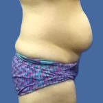 Body Contouring Before & After Patient #5346