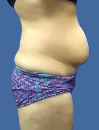 Body Contouring Before & After Patient #5346