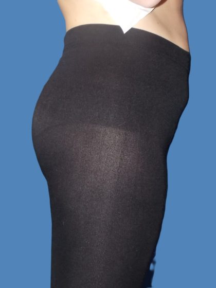 Body Contouring Before & After Patient #5346