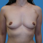 Tissue Expander To Implant Breast Reconstruction Before & After Patient #5384