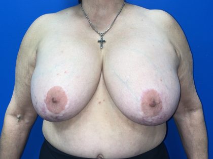 Breast Explant Before & After Patient #5420