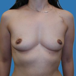 Tissue Expander To Implant Breast Reconstruction Before & After Patient #5384