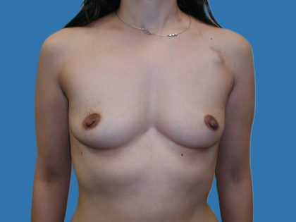 Tissue Expander To Implant Breast Reconstruction Before & After Patient #5384