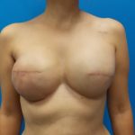 Tissue Expander To Implant Breast Reconstruction Before & After Patient #5384