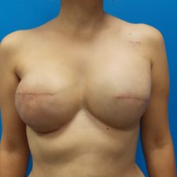 Tissue Expander To Implant Breast Reconstruction Before & After Patient #5384