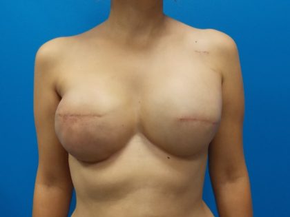 Tissue Expander To Implant Breast Reconstruction Before & After Patient #5384