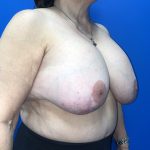 Breast Explant Before & After Patient #5420