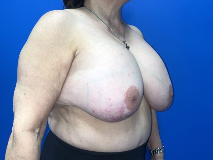 Breast Explant Before & After Patient #5420