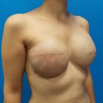 Tissue Expander To Implant Breast Reconstruction Before & After Patient #5384