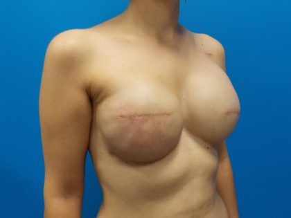 Tissue Expander To Implant Breast Reconstruction Before & After Patient #5384