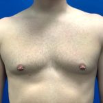 Breast Explant Before & After Patient #5371