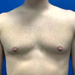 Breast Explant Before & After Patient #5371